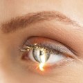 Will Laser Eye Surgery Last a Lifetime?