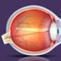 Can You Get Laser Eye Surgery with Astigmatism and Myopia?