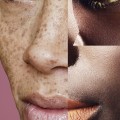 Laser Eye Surgery on Dark Skin: Considerations and Treatments