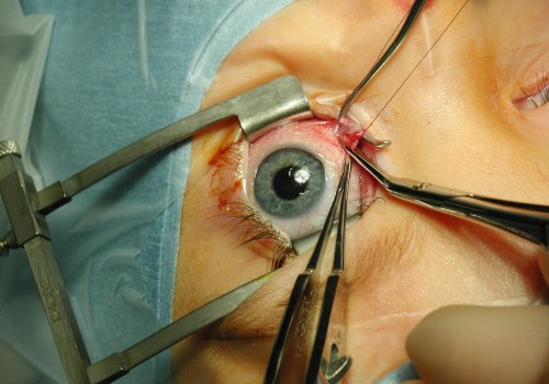 Is Laser Eye Surgery a Good Idea?