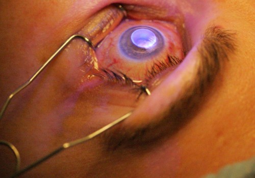 What to Expect After Laser Eye Surgery
