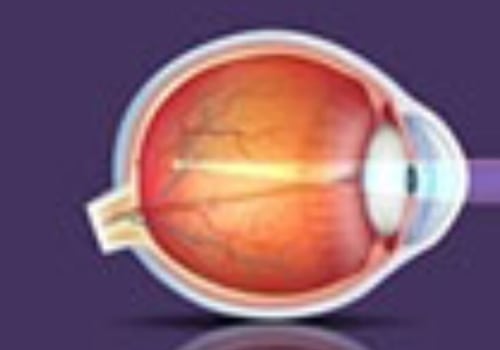 How LASIK Surgery Can Correct Myopia, Astigmatism and Farsightedness